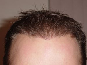 1 Month Post 2nd Hair Transplant Procedure
