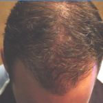 6 Months After Hair Transplant Procedure