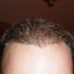 7 Months After Hair Transplant Procedure