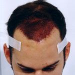 After Hair Transplant Procedure