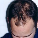 Before Hair Transplant Procedure