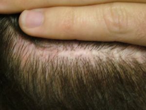 Donor Hair After 1 month