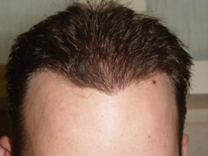 Wet Hair Post 2nd Hair Transplant Procedure