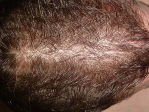 Wet Hair Post 2nd Hair Transplant Procedure