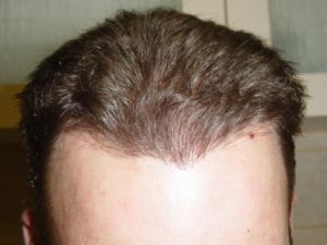 Dry Hair Post 2nd Hair Transplant Procedure