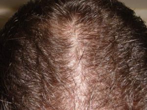Wet Hair Post 2nd Hair Transplant Procedure