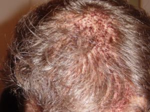 Post 2nd Hair Transplant Procedure